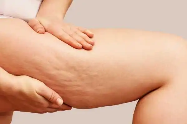 Image of woman showing leg with cellulite Oakham