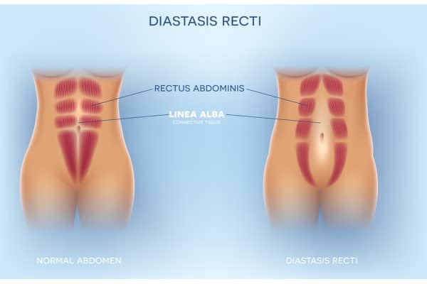 What Non-Surgical Options Are Available for Diastasis Recti Oakham?
