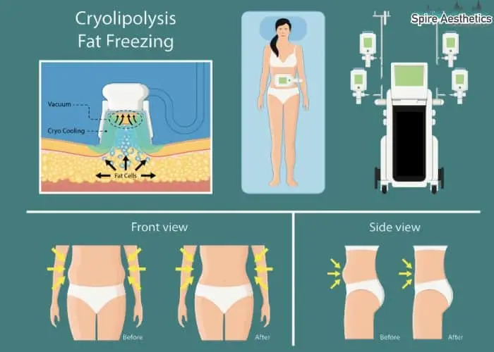 Fat freezing treatment Oakham benefits for competitions to remove stubborn fat deposits.