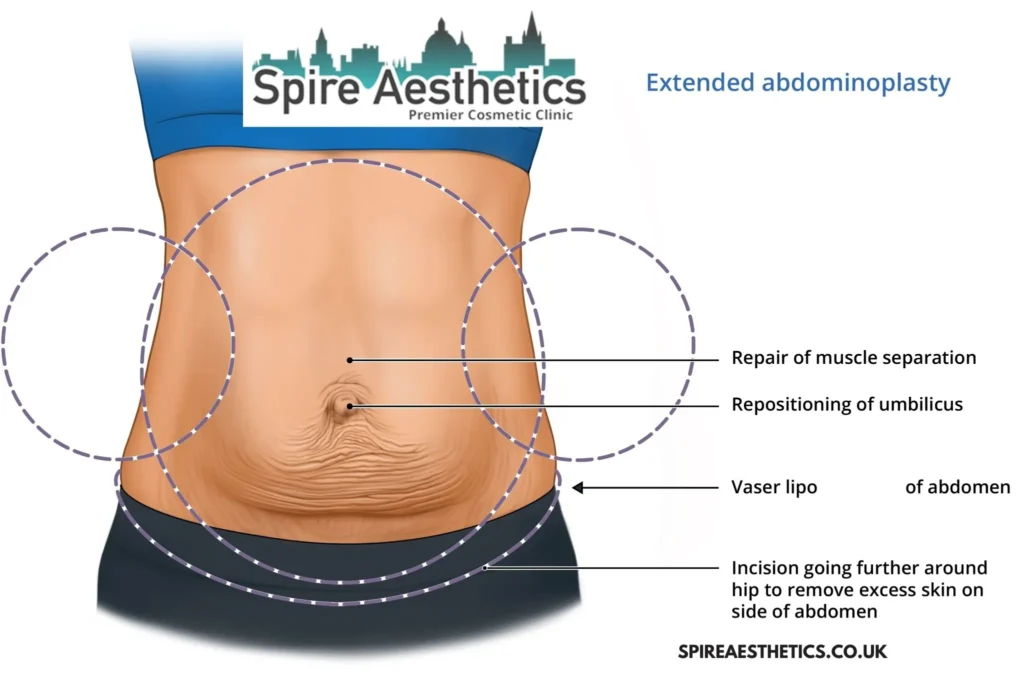 Understanding Loose Skin After Gastric Band Oakham Surgery and HIFU Treatment