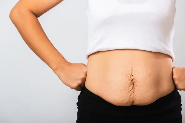 Image of a woman's stomach after weight loss with sagging skin following a gastric band Oakham