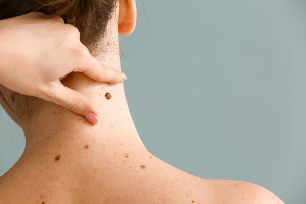 skin blemish removal Oakham treatment