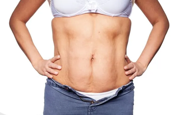 sagging skin on woman's stomach after weight loss injections Oakham