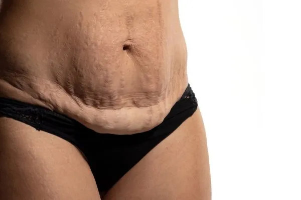 Image of womans stomach after weight loss injections Oakham showing saggy skin