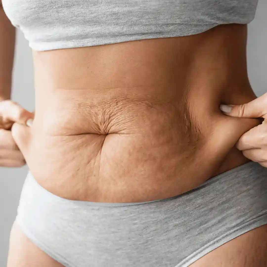 Is It Normal to Have Loose Skin After Pregnancy Oakham?